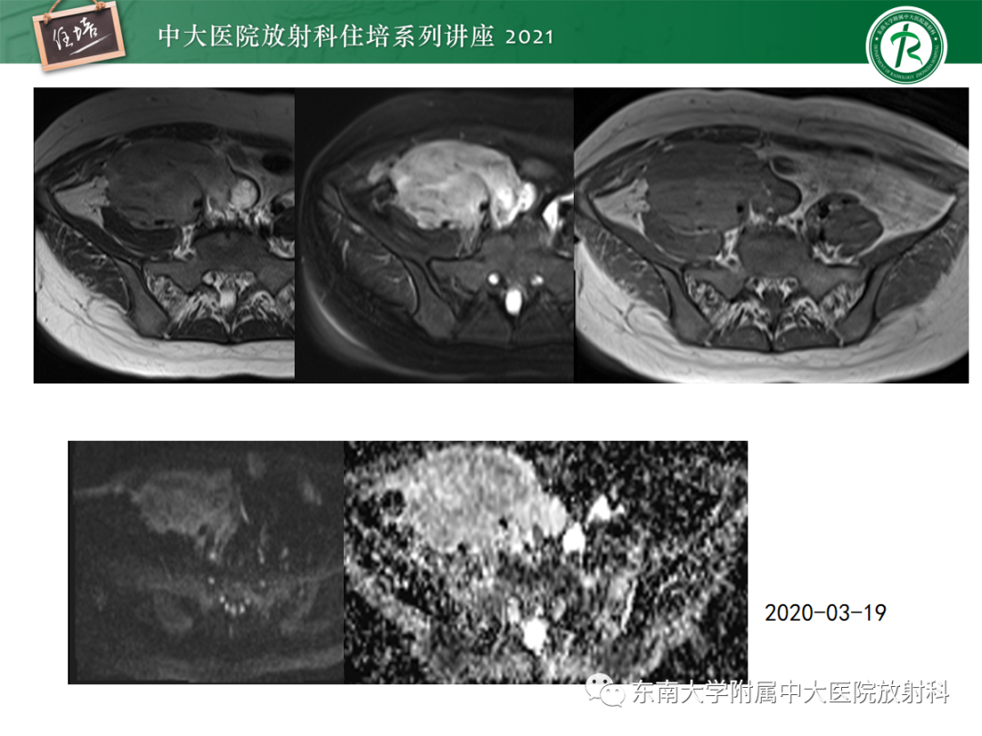 影像PPT - 【PPT】腹膜病变的影像分析思路-9
