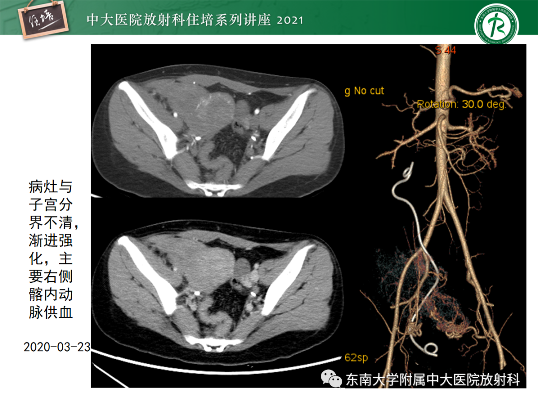 影像PPT - 【PPT】腹膜病变的影像分析思路-11