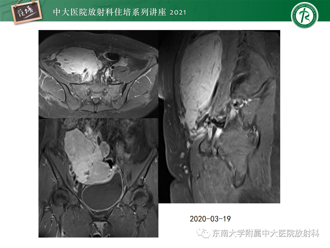 影像PPT - 【PPT】腹膜病变的影像分析思路-10