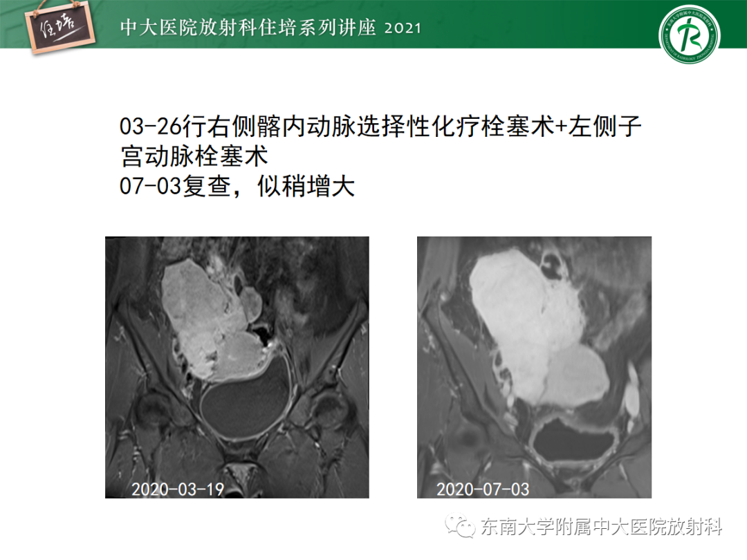 影像PPT - 【PPT】腹膜病变的影像分析思路-12