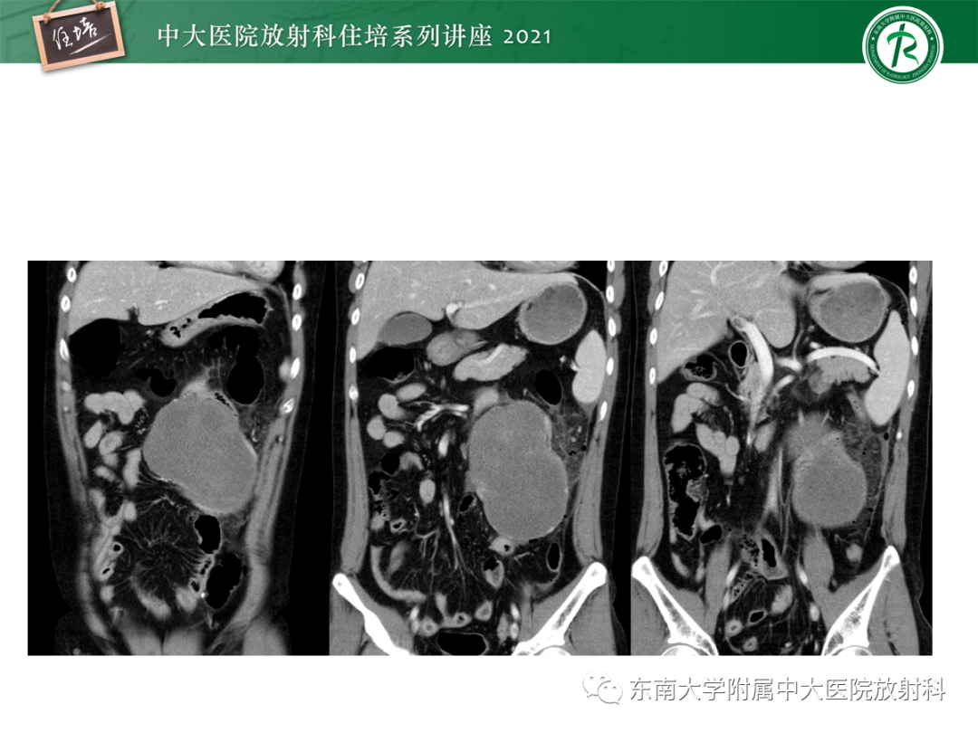 影像PPT - 【PPT】腹膜病变的影像分析思路-15