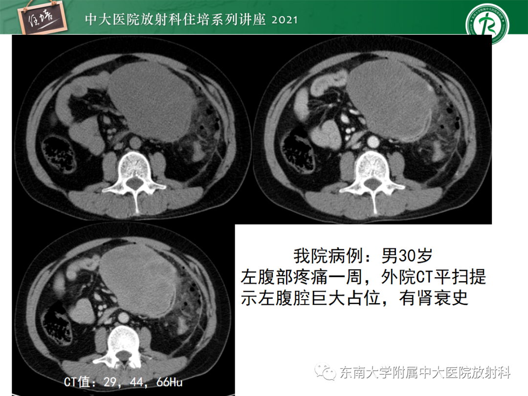 影像PPT - 【PPT】腹膜病变的影像分析思路-14