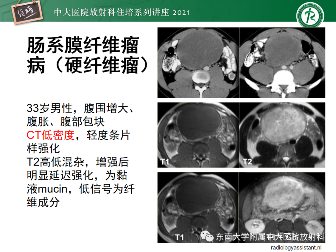 影像PPT - 【PPT】腹膜病变的影像分析思路-19