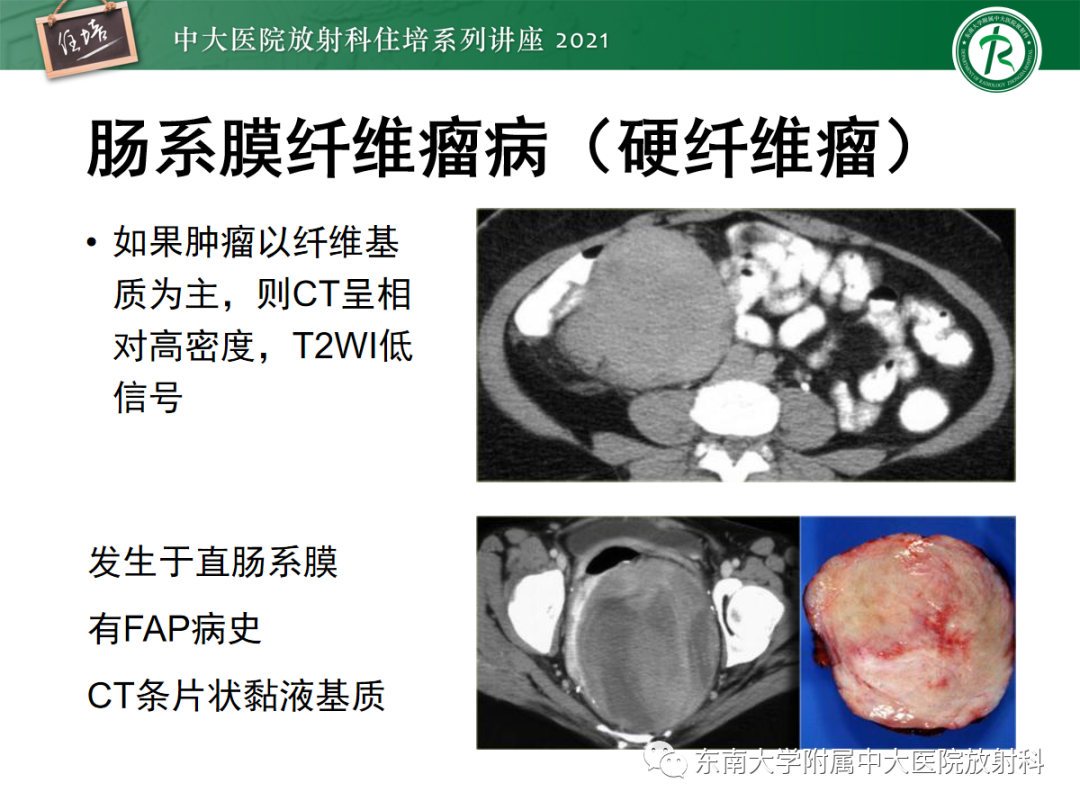 影像PPT - 【PPT】腹膜病变的影像分析思路-20