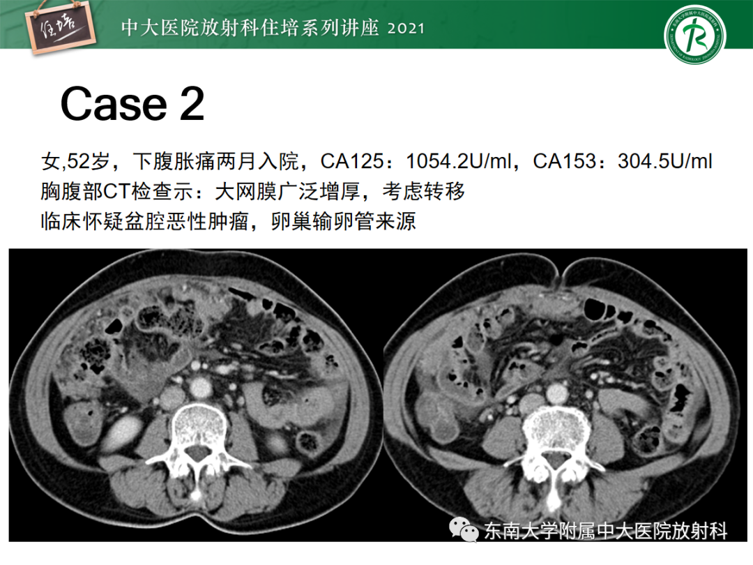 影像PPT - 【PPT】腹膜病变的影像分析思路-23