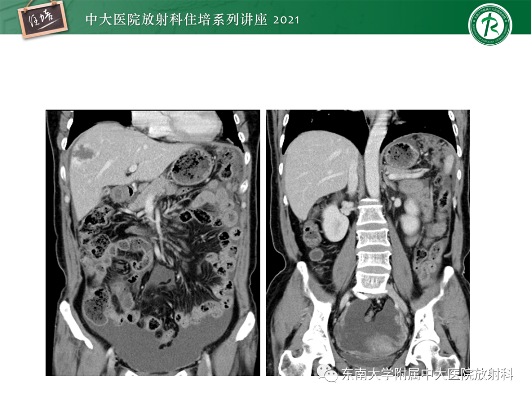 影像PPT - 【PPT】腹膜病变的影像分析思路-24
