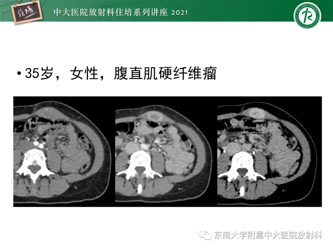 影像PPT - 【PPT】腹膜病变的影像分析思路-21