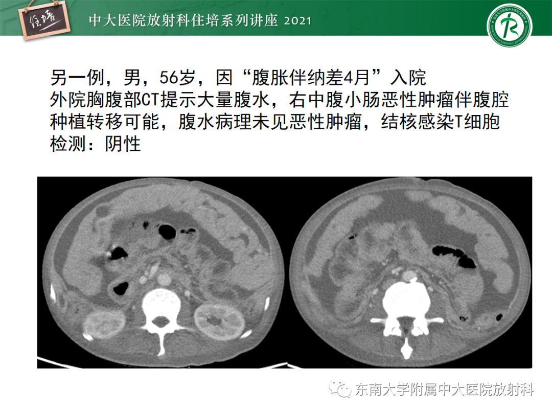 影像PPT - 【PPT】腹膜病变的影像分析思路-27