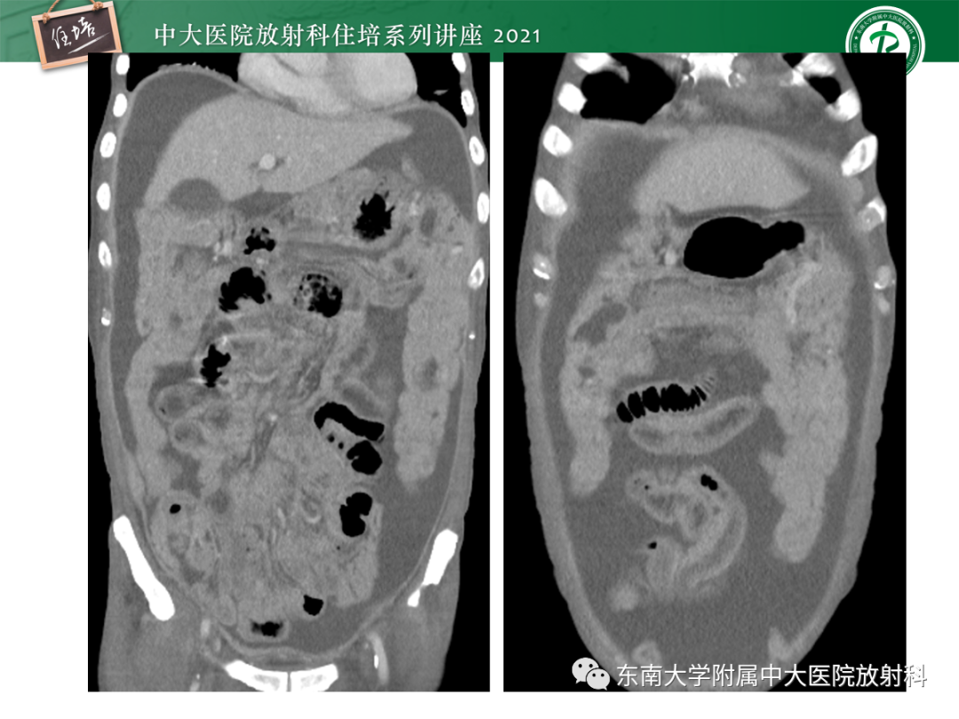 影像PPT - 【PPT】腹膜病变的影像分析思路-28