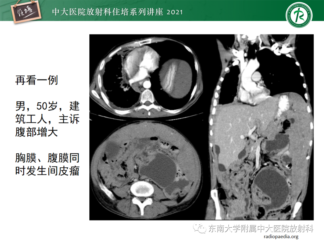 影像PPT - 【PPT】腹膜病变的影像分析思路-32