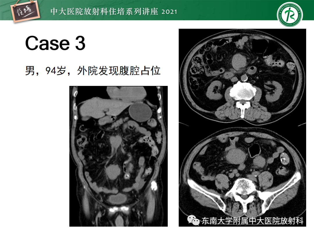 影像PPT - 【PPT】腹膜病变的影像分析思路-33