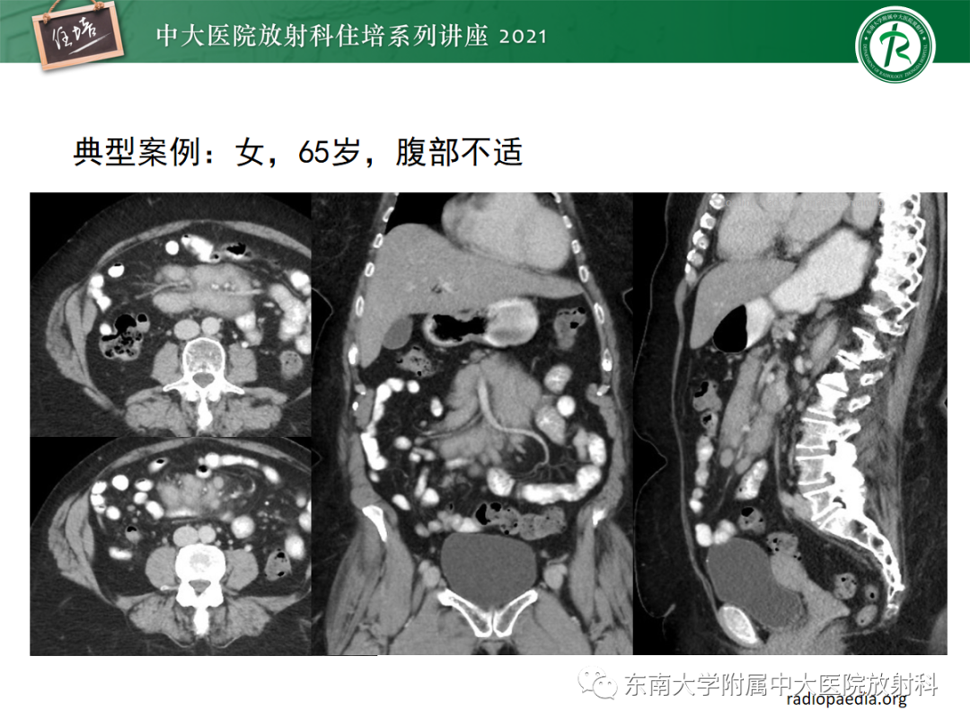 影像PPT - 【PPT】腹膜病变的影像分析思路-36