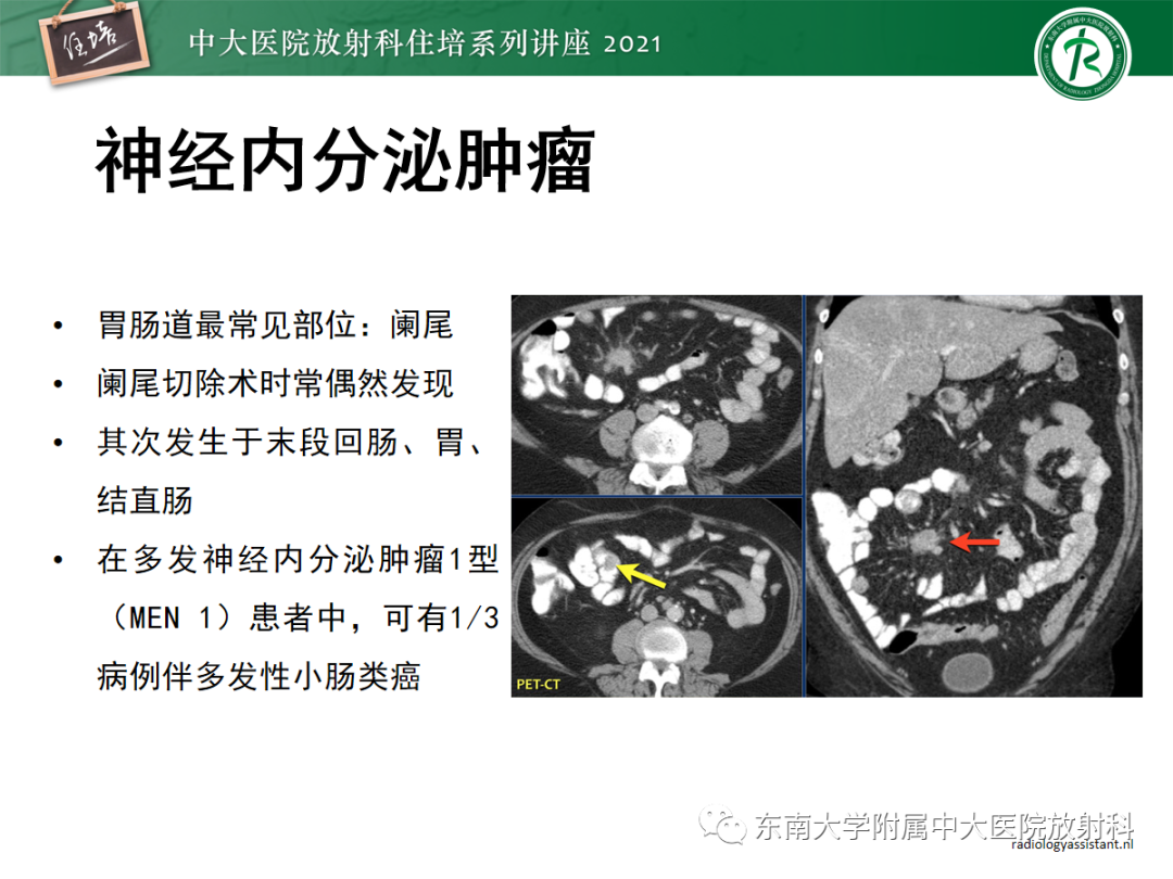 影像PPT - 【PPT】腹膜病变的影像分析思路-40