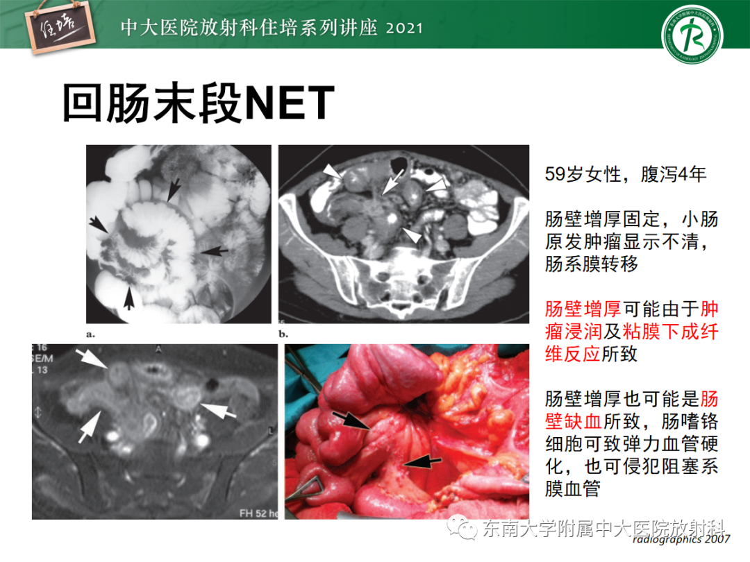 影像PPT - 【PPT】腹膜病变的影像分析思路-42