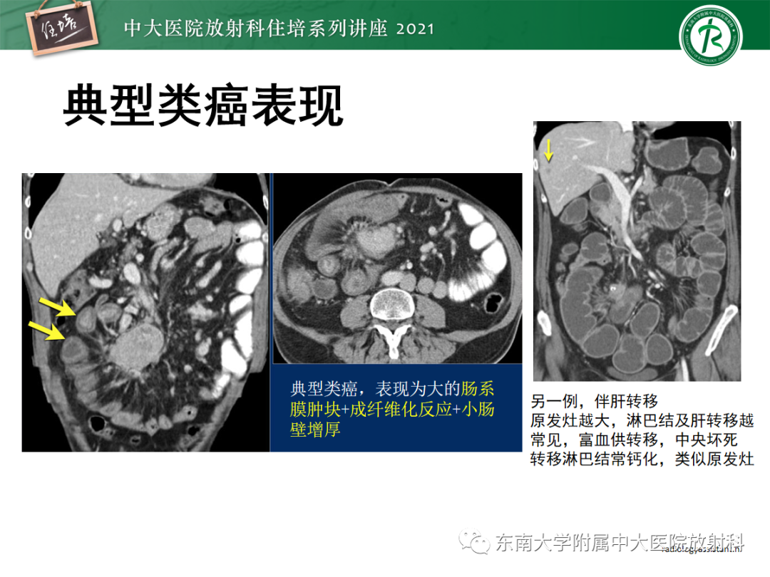 影像PPT - 【PPT】腹膜病变的影像分析思路-43