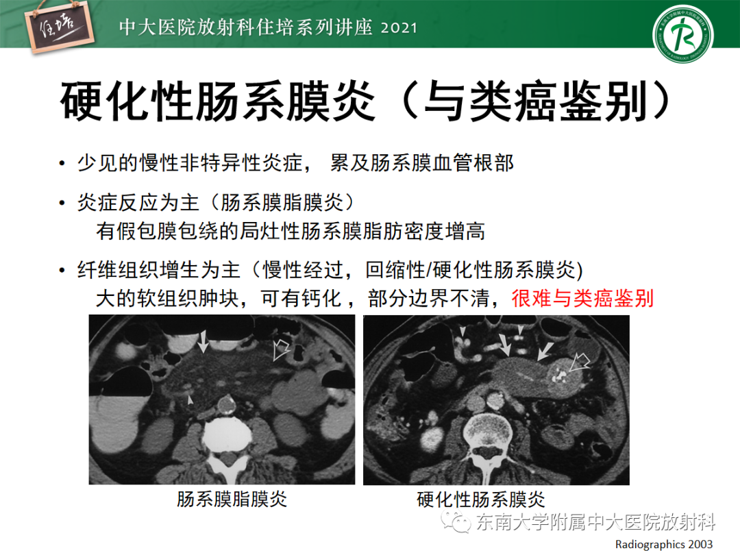 影像PPT - 【PPT】腹膜病变的影像分析思路-44