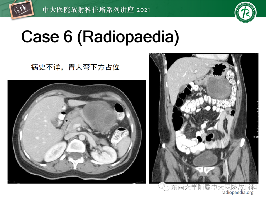 影像PPT - 【PPT】腹膜病变的影像分析思路-51
