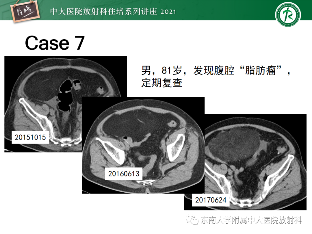 影像PPT - 【PPT】腹膜病变的影像分析思路-53