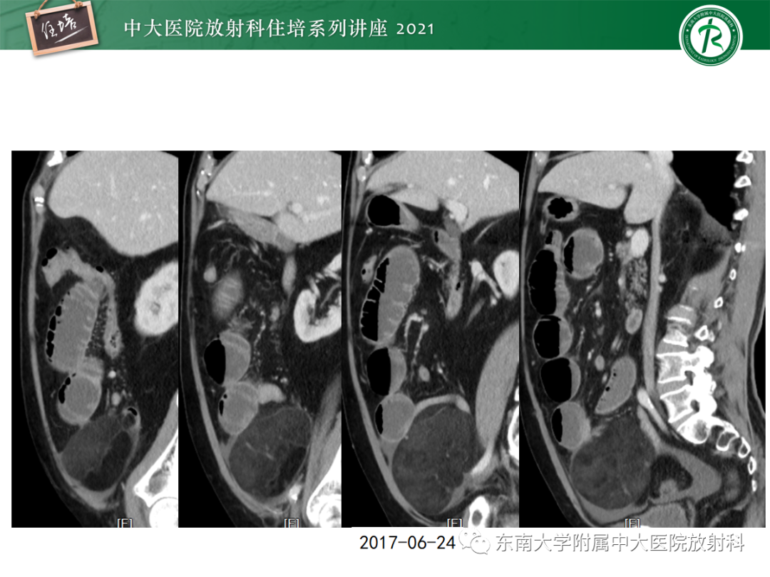 影像PPT - 【PPT】腹膜病变的影像分析思路-55