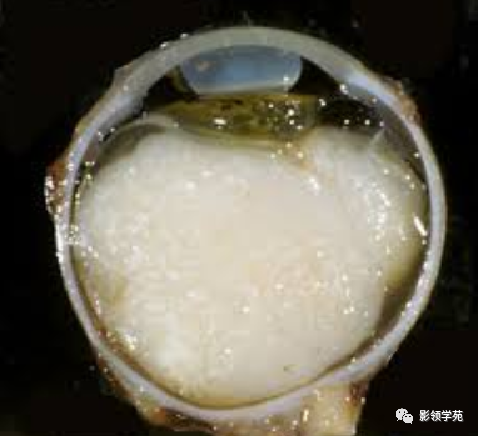 影像PPT - 视网膜母细胞瘤(RB)影像学表现-2 影像PPT - 视网膜母细胞瘤(RB)影像学表现-2