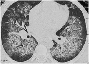 影像PPT - 胸部 CT 弥漫或多发磨玻璃影的影像鉴别诊断-11 影像PPT - 胸部 CT 弥漫或多发磨玻璃影的影像鉴别诊断-11