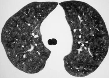 影像PPT - 胸部 CT 弥漫或多发磨玻璃影的影像鉴别诊断-12 影像PPT - 胸部 CT 弥漫或多发磨玻璃影的影像鉴别诊断-12