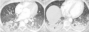 影像PPT - 胸部 CT 弥漫或多发磨玻璃影的影像鉴别诊断-13 影像PPT - 胸部 CT 弥漫或多发磨玻璃影的影像鉴别诊断-13