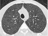 影像PPT - 胸部 CT 弥漫或多发磨玻璃影的影像鉴别诊断-14 影像PPT - 胸部 CT 弥漫或多发磨玻璃影的影像鉴别诊断-14