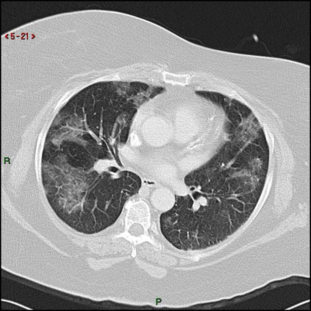 影像PPT - 胸部 CT 弥漫或多发磨玻璃影的影像鉴别诊断-19 影像PPT - 胸部 CT 弥漫或多发磨玻璃影的影像鉴别诊断-19