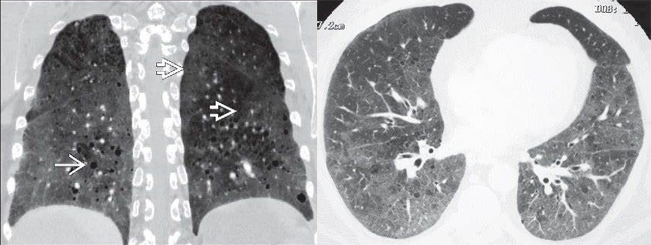 影像PPT - 胸部 CT 弥漫或多发磨玻璃影的影像鉴别诊断-17 影像PPT - 胸部 CT 弥漫或多发磨玻璃影的影像鉴别诊断-17