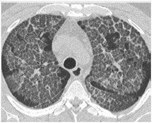影像PPT - 胸部 CT 弥漫或多发磨玻璃影的影像鉴别诊断-20 影像PPT - 胸部 CT 弥漫或多发磨玻璃影的影像鉴别诊断-20