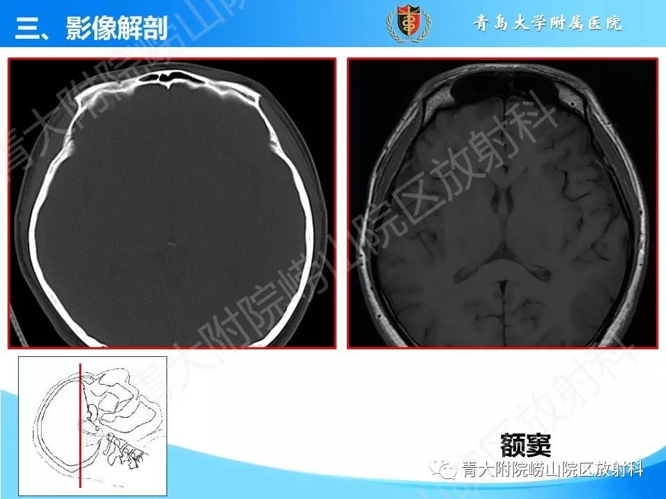 影像PPT - 【PPT】鼻和鼻窦解剖及常见病影像诊断-11