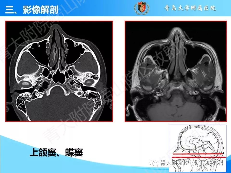 影像PPT - 【PPT】鼻和鼻窦解剖及常见病影像诊断-13