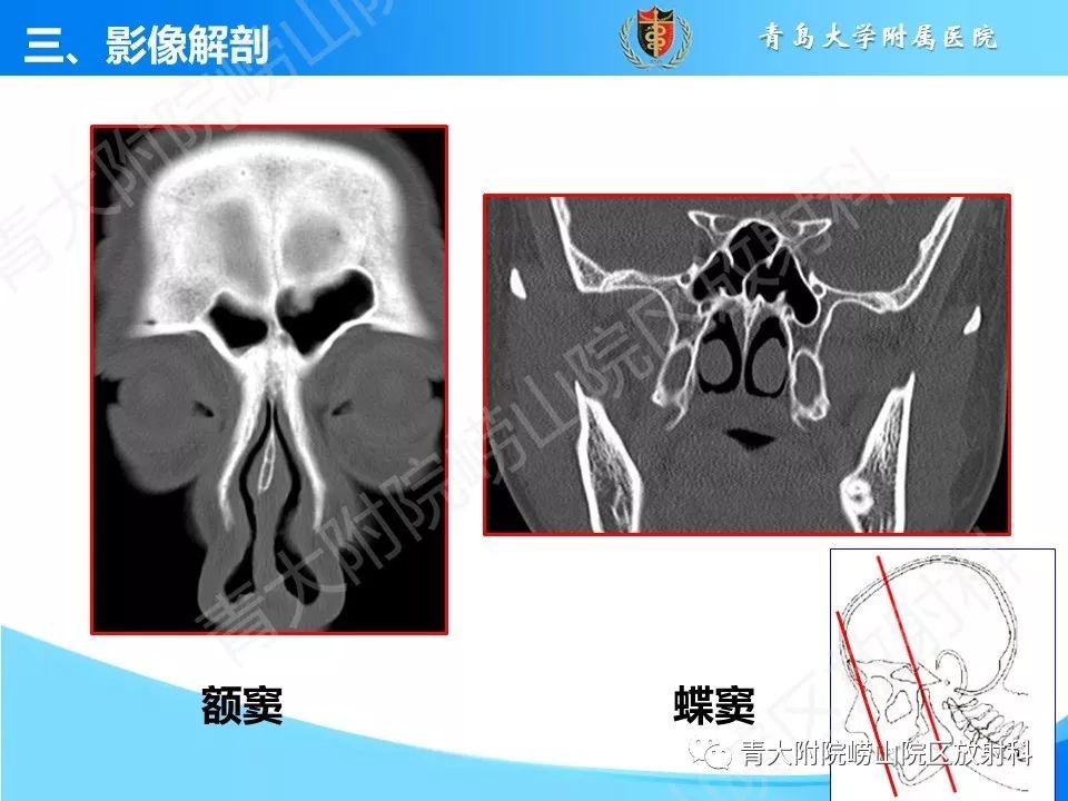 影像PPT - 【PPT】鼻和鼻窦解剖及常见病影像诊断-15