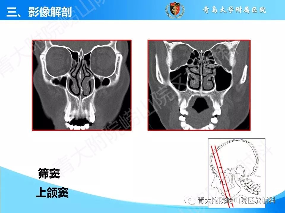 影像PPT - 【PPT】鼻和鼻窦解剖及常见病影像诊断-14
