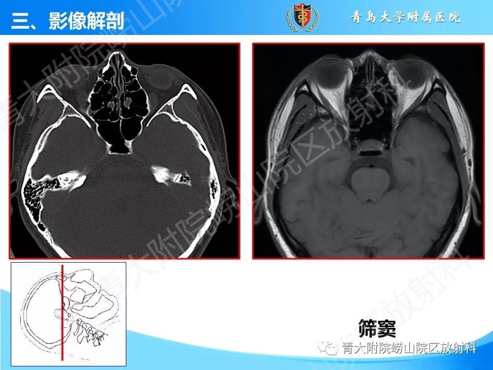 影像PPT - 【PPT】鼻和鼻窦解剖及常见病影像诊断-12