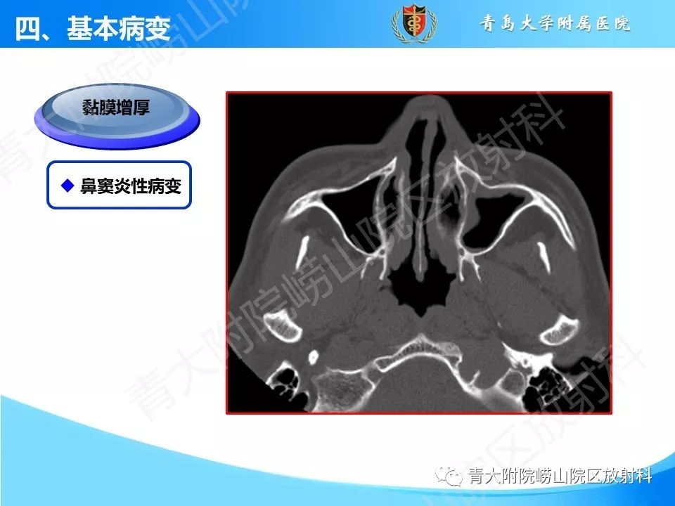 影像PPT - 【PPT】鼻和鼻窦解剖及常见病影像诊断-16