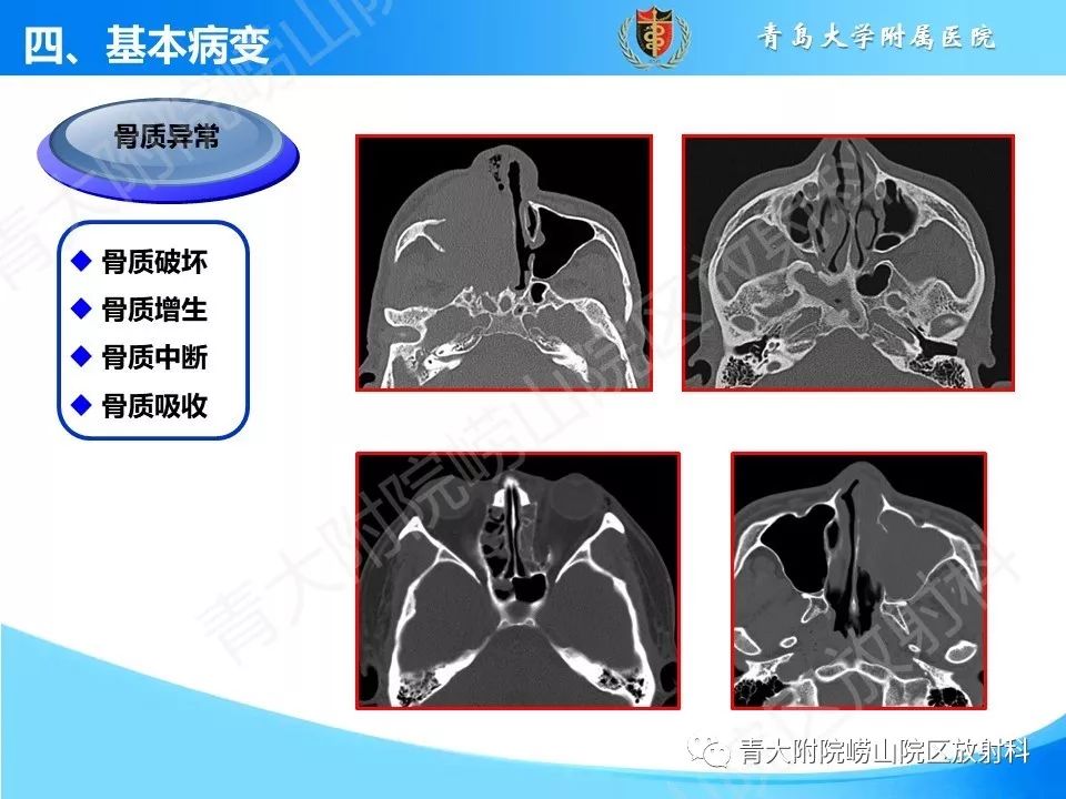 影像PPT - 【PPT】鼻和鼻窦解剖及常见病影像诊断-20
