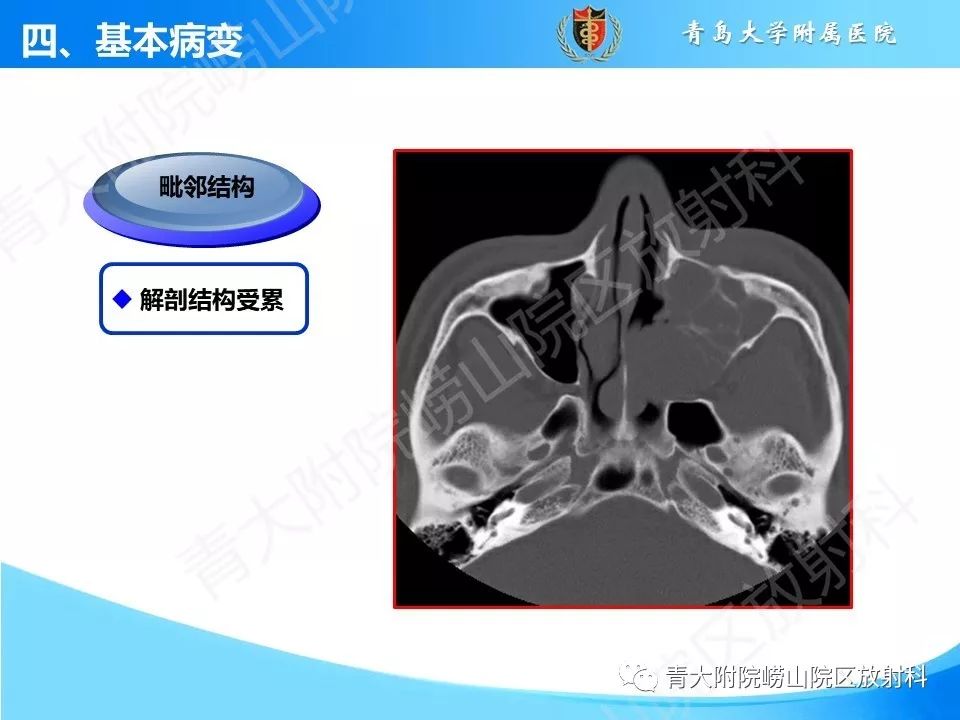 影像PPT - 【PPT】鼻和鼻窦解剖及常见病影像诊断-21