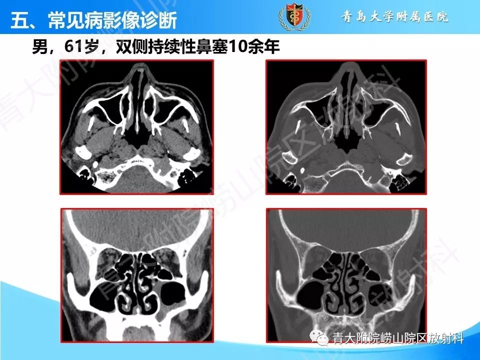 影像PPT - 【PPT】鼻和鼻窦解剖及常见病影像诊断-27