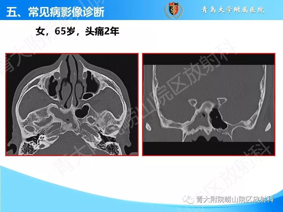 影像PPT - 【PPT】鼻和鼻窦解剖及常见病影像诊断-29