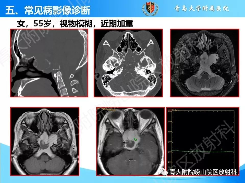 影像PPT - 【PPT】鼻和鼻窦解剖及常见病影像诊断-36