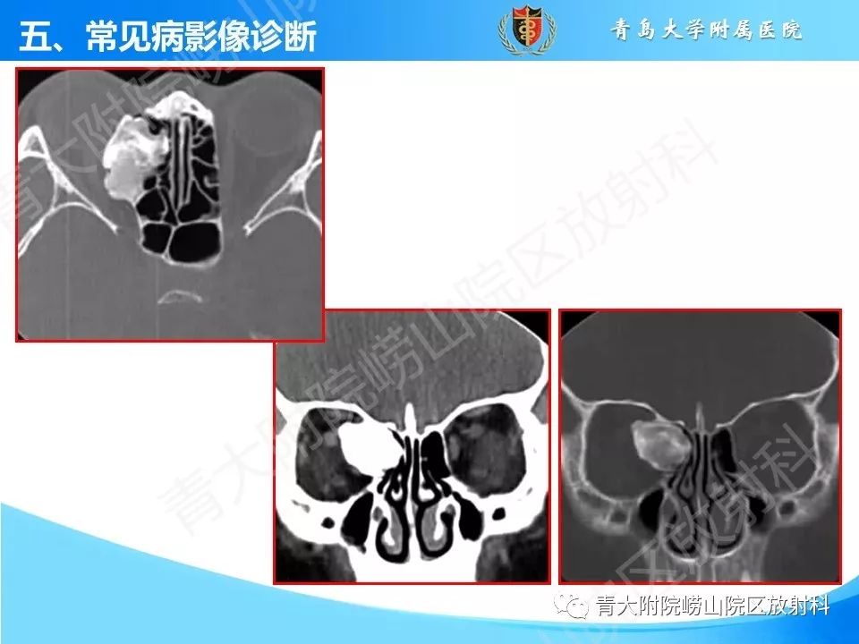 影像PPT - 【PPT】鼻和鼻窦解剖及常见病影像诊断-42