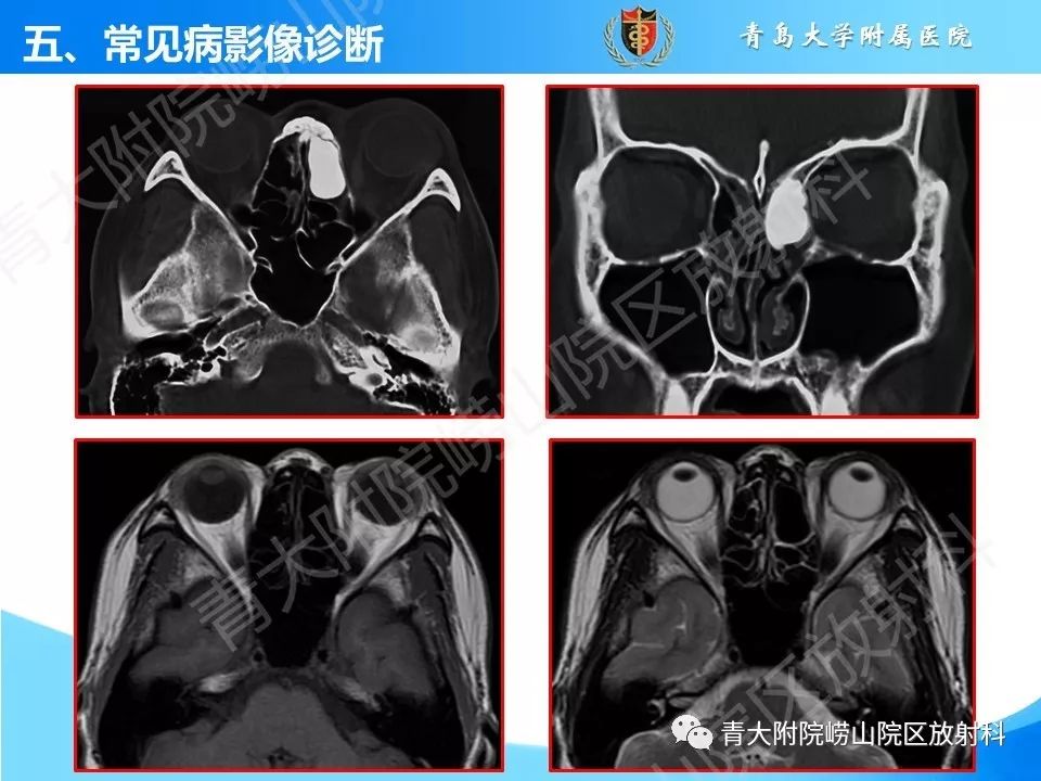 影像PPT - 【PPT】鼻和鼻窦解剖及常见病影像诊断-43