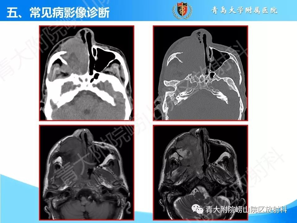 影像PPT - 【PPT】鼻和鼻窦解剖及常见病影像诊断-47