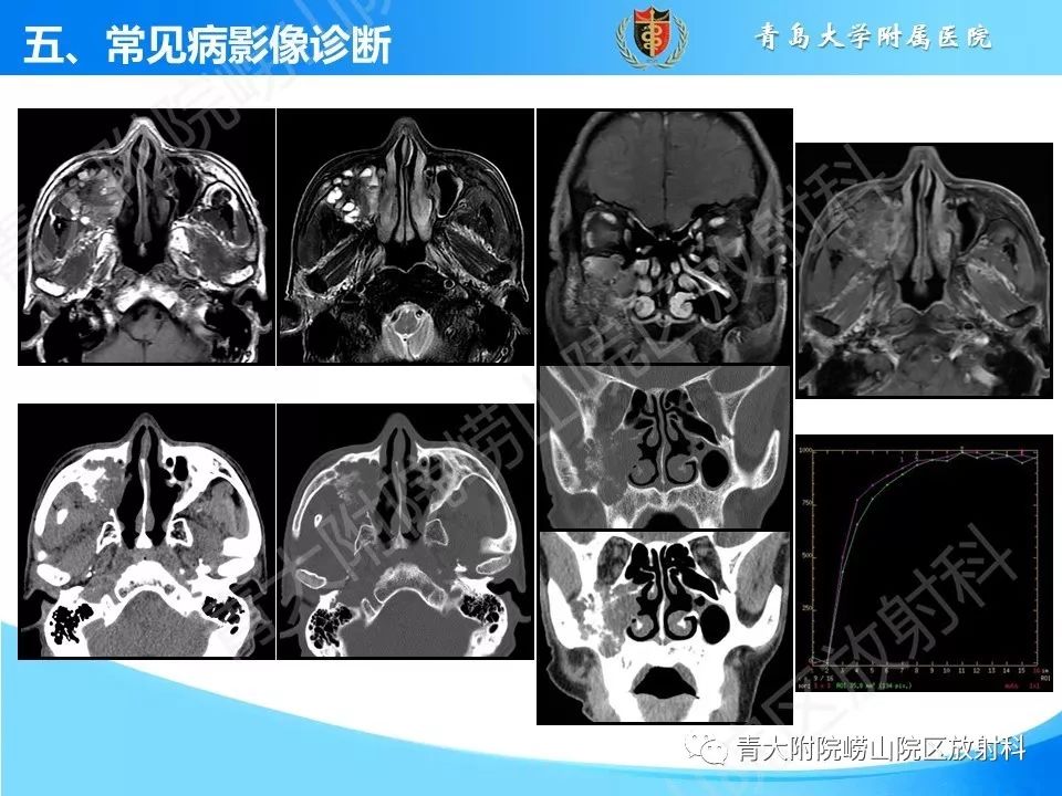 影像PPT - 【PPT】鼻和鼻窦解剖及常见病影像诊断-48