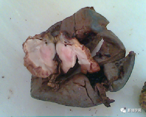 影像PPT - 脾脏肿瘤CT诊断-11 影像PPT - 脾脏肿瘤CT诊断-11