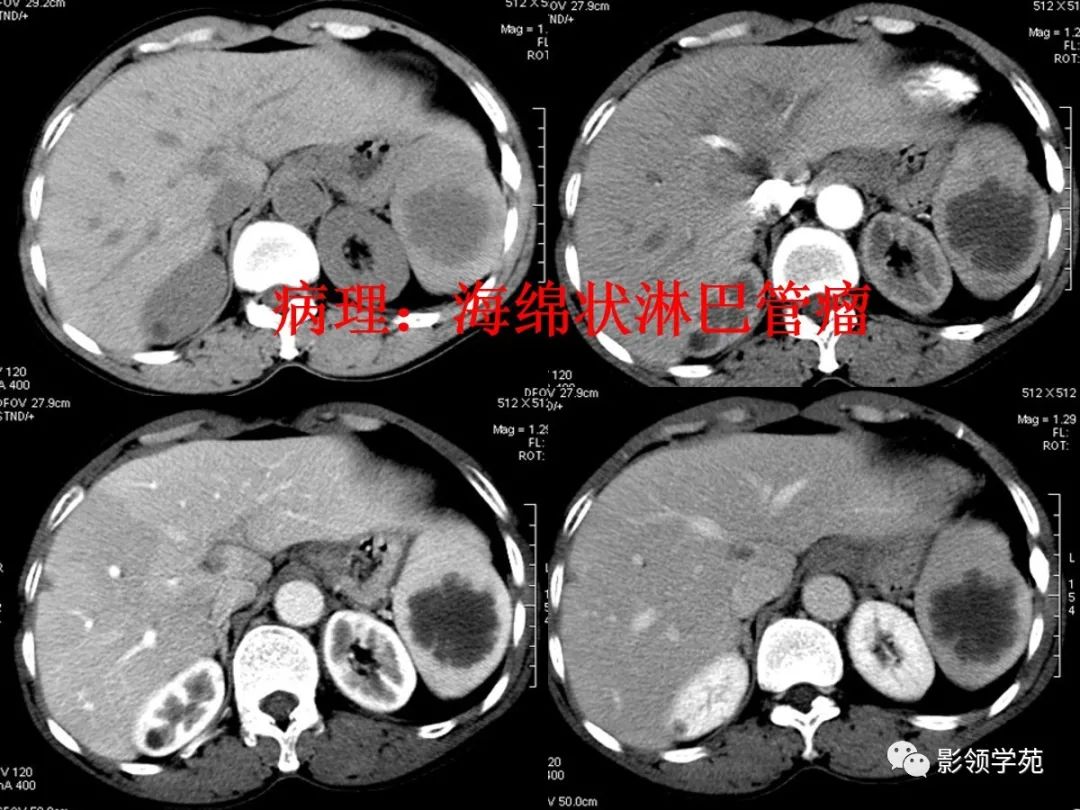 影像PPT - 脾脏肿瘤CT诊断-22 影像PPT - 脾脏肿瘤CT诊断-22