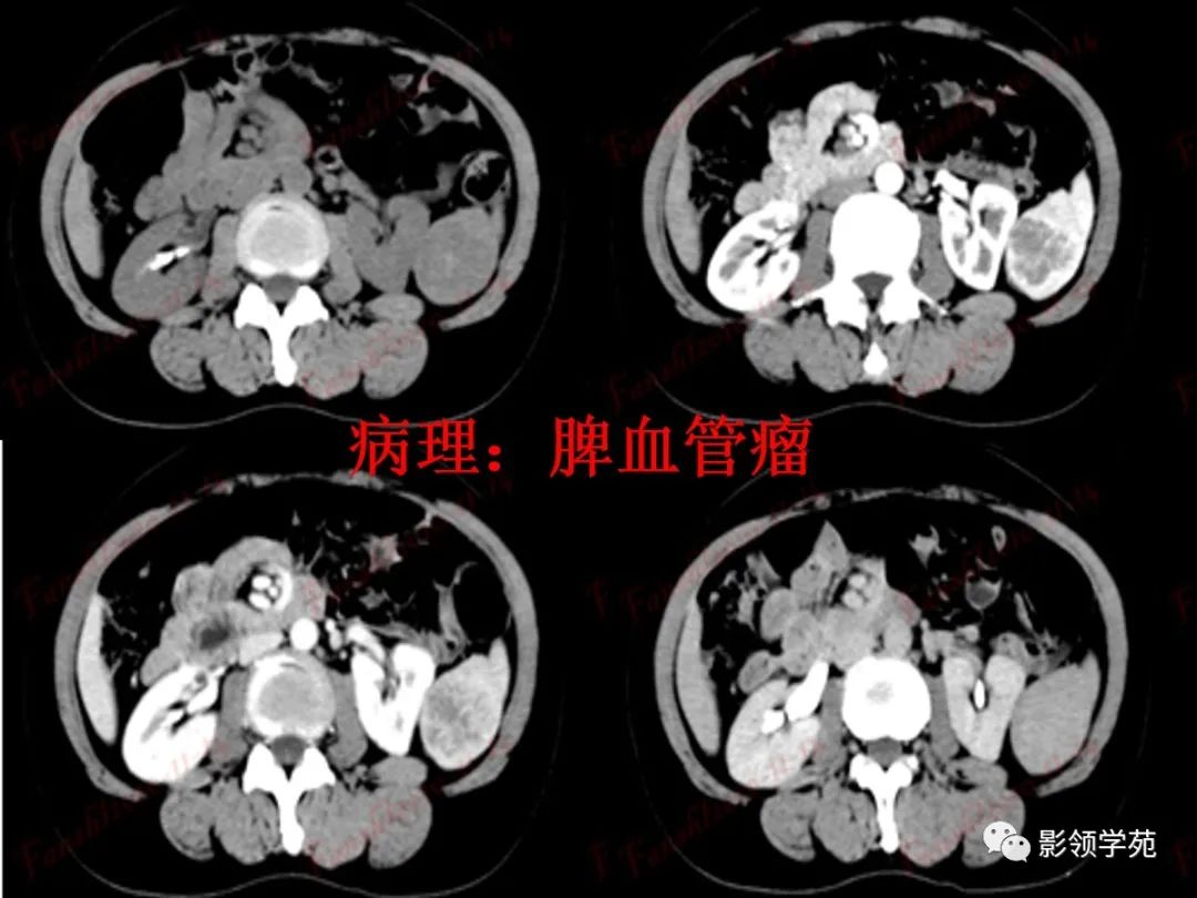 影像PPT - 脾脏肿瘤CT诊断-23 影像PPT - 脾脏肿瘤CT诊断-23