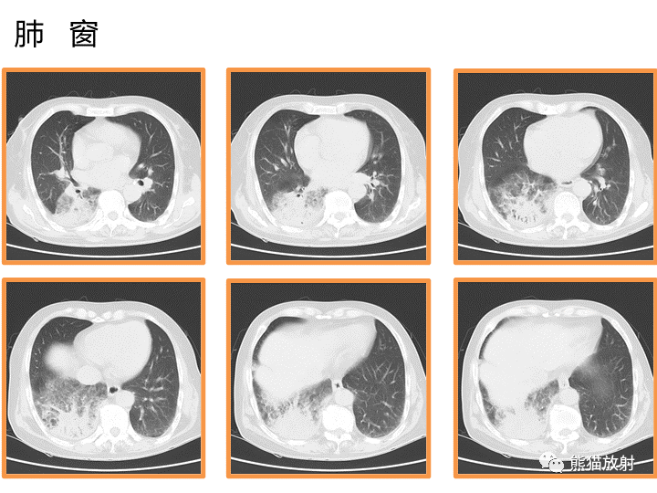 影像PPT - 【病例】肺黏液腺癌2例CT影像-3